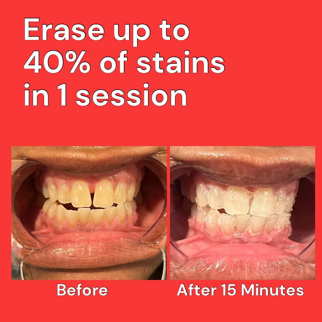 One and Done Teeth Whitening Kit